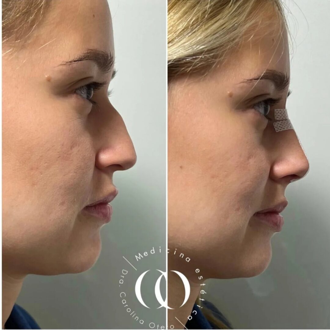 Rinomodelación realizada por la Doctora Carolina Otero